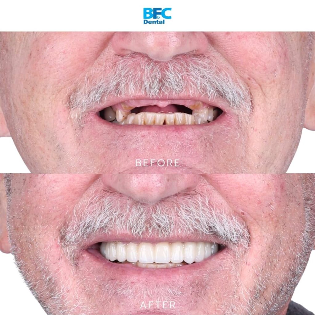 Upper Full Mouth Implants