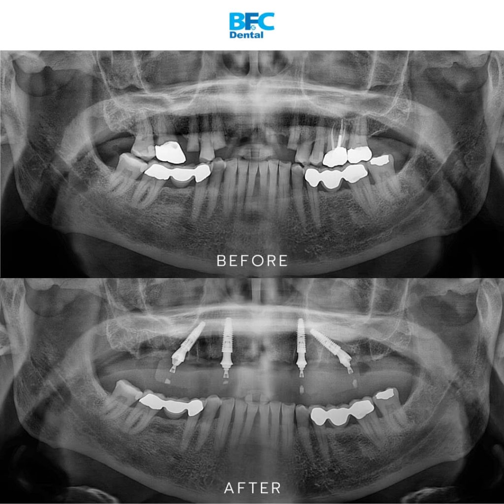 Upper Full Mouth Implants