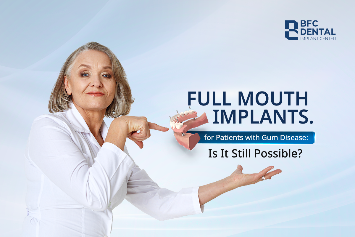 Full Mouth Implants