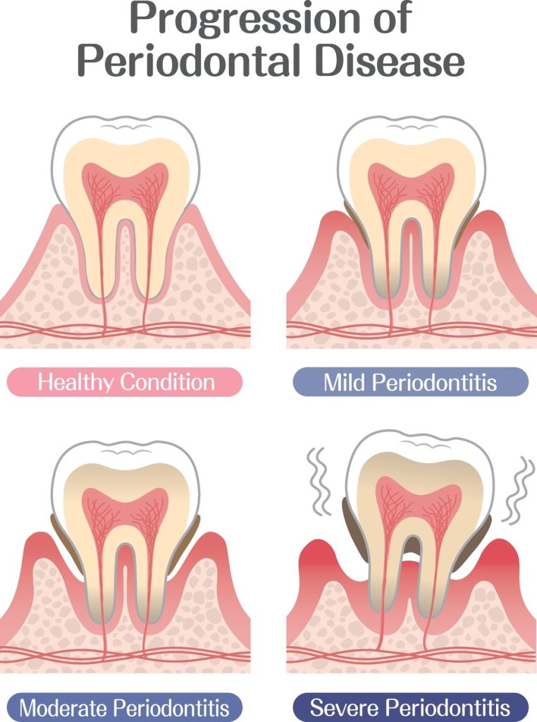 Full Mouth Implants